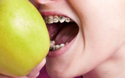 Qué alimentos evitar si usas brackets