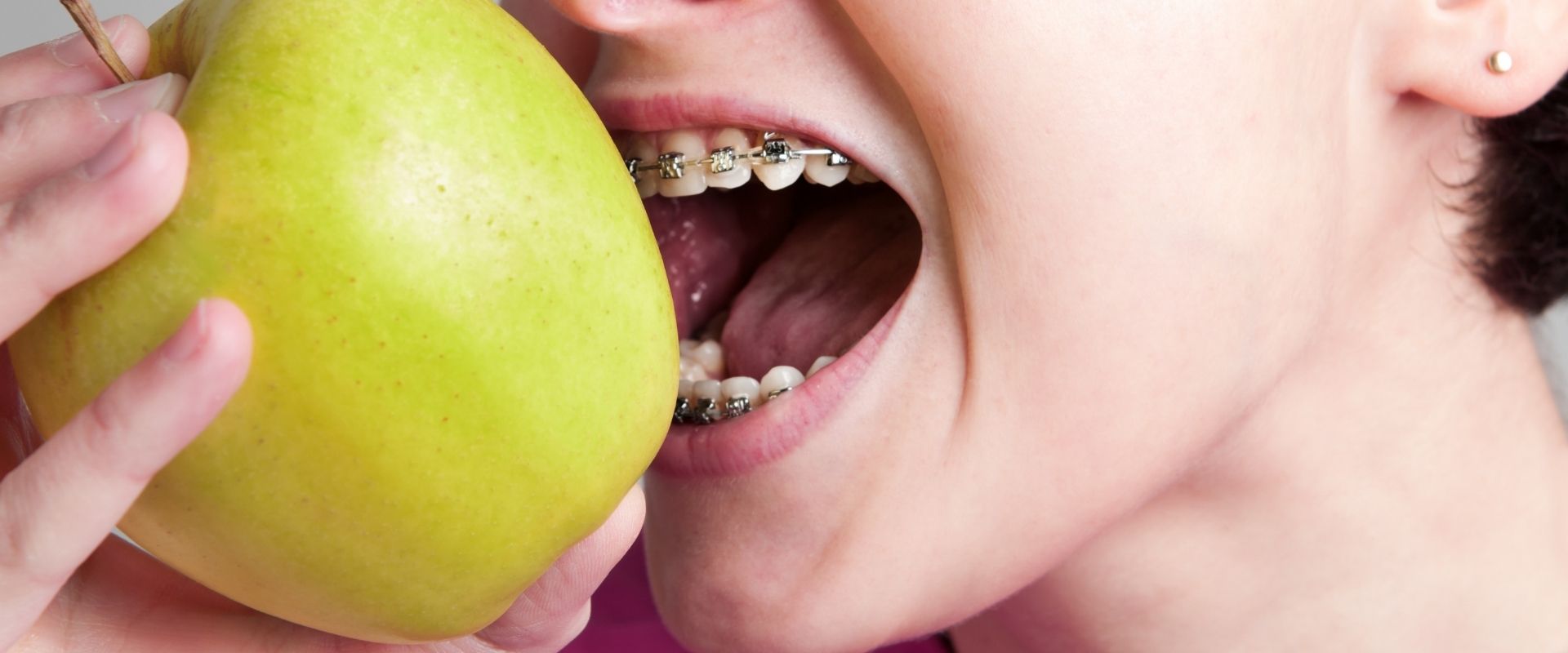 alimentos evitar brackets blog alimentos evitar brackets blog