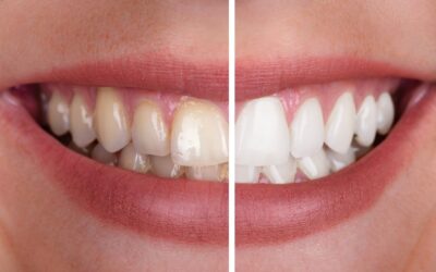 Tipos de blanqueamiento dental
