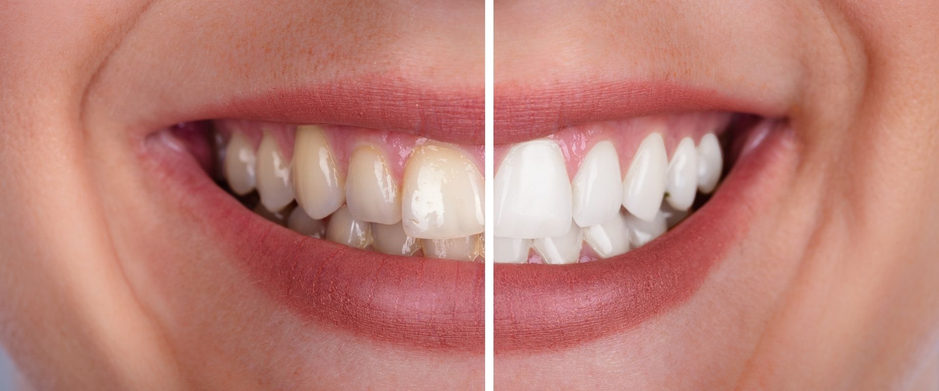 blanqueamiento dental blog blanqueamiento dental blog