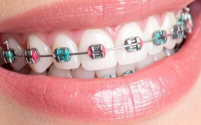 Cómo mantener tu ortodoncia saludable