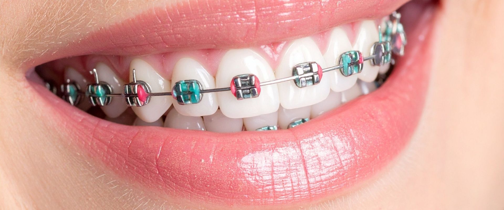 ortodoncia saludable blog ortodoncia saludable blog